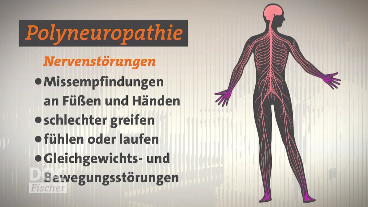 Doc Fischer: Polyneuropathie - wenn die Nerven verrücktspielen ...